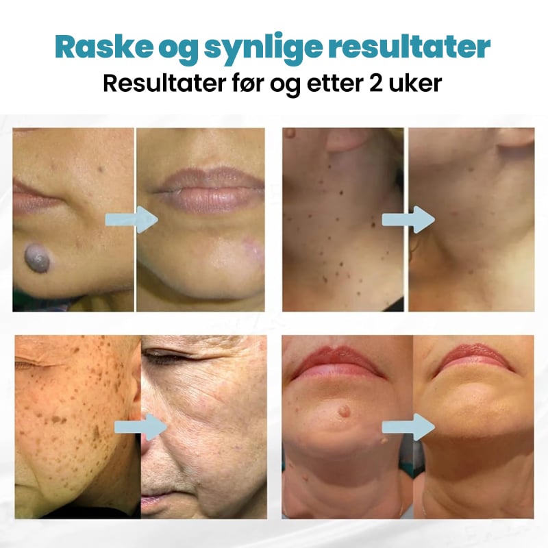 Ikke-Invasiv Laserpenn For Fjerning Av Føflekker Og Vorter