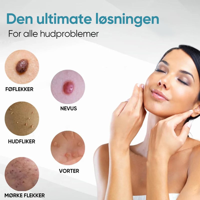 Sporløs Fregnefjerning Laser Føflekkfjerning Skjønnhetsinstrument