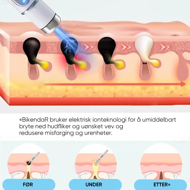 Sporløs Fregnefjerning Laser Føflekkfjerning Skjønnhetsinstrument