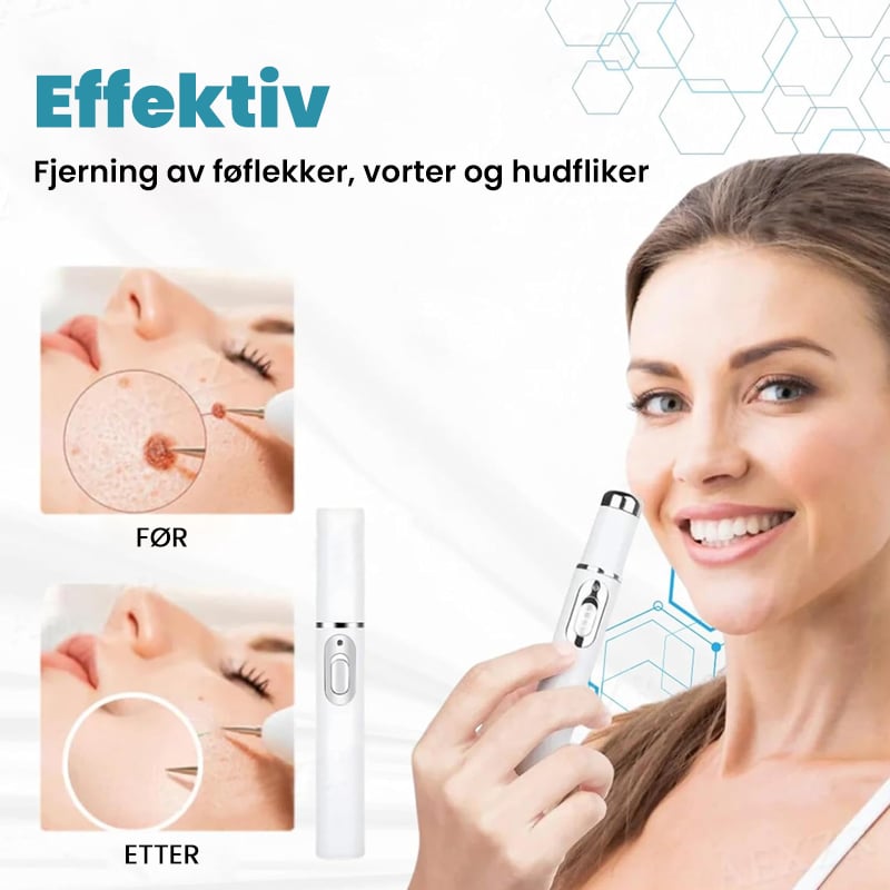 Ikke-Invasiv Laserpenn For Fjerning Av Føflekker Og Vorter