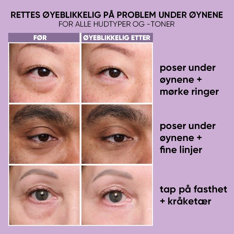 Midlertidig Øyestrammer