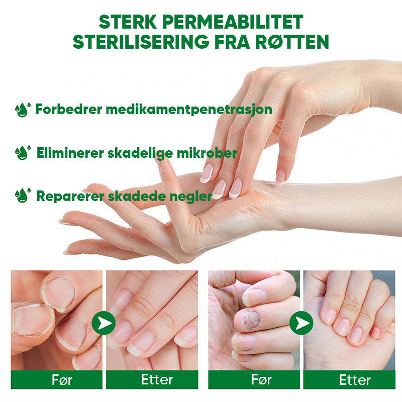Ingefær Negle Behandling