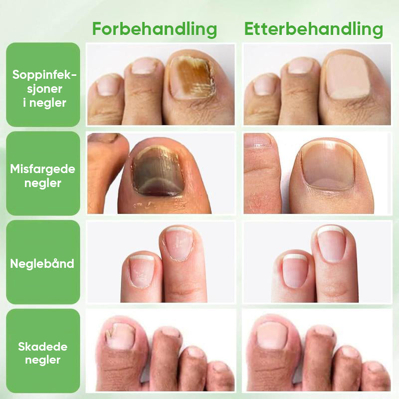Ingefær Negle Behandling