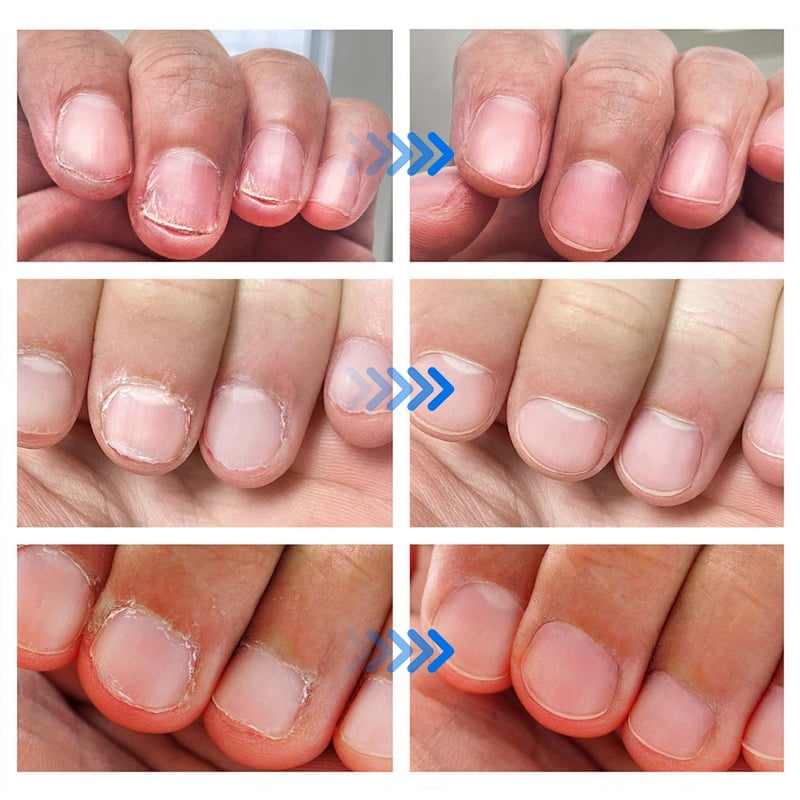 Soppdrepende neglereparasjonsløsning