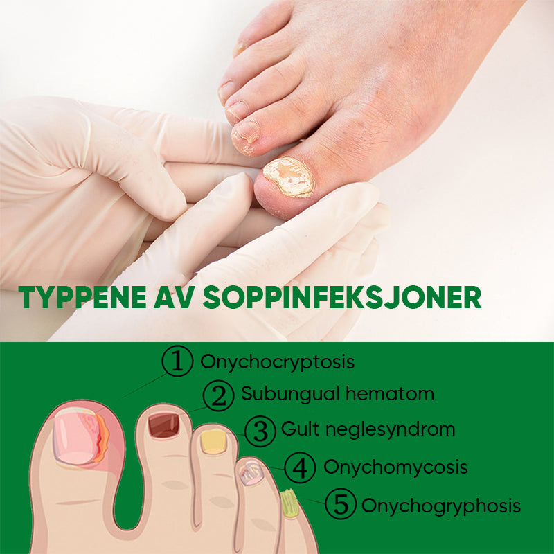 Ingefær Negle Behandling